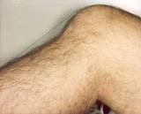 La tibia cae hacia atrás