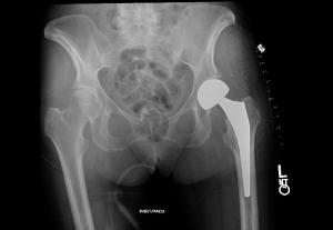 Protesis cadera (hemiartroplastia)